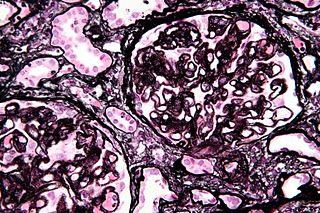 Membranous_nephropathy_-_mpas_-_very_high_mag.jpg