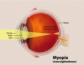 Myopia.jpg